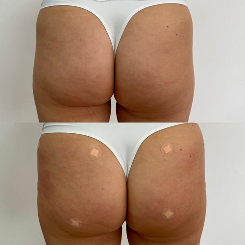 Non Surgical Butt Lift in Byfleet Surrey