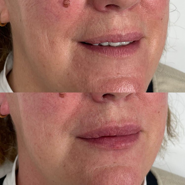 Botox Brow Lift in Green Park, London